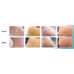 Stylo de cryothérapie Freezpen 16g avec ses 3 applicateurs interchangeables pour le traitement des verrues et lésions cutanées